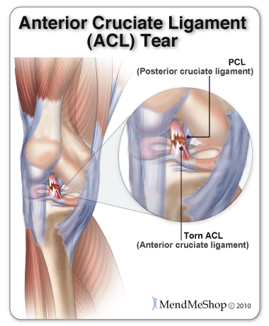 ACL injuries Most Common football injuries 
